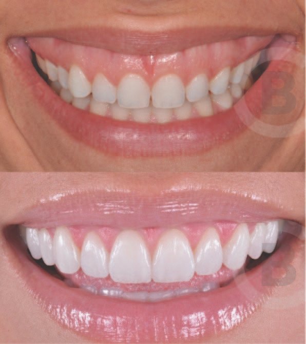 Tratamiento de Sonrisa Gingival - Bioestimulación